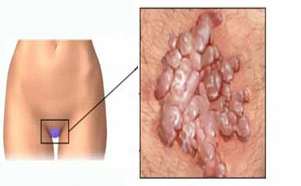 Hpv tedavisi olanlar - Hpv nin tedavisi bulundu